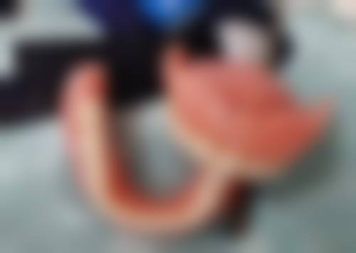 前牙反𬌗的矫治原则