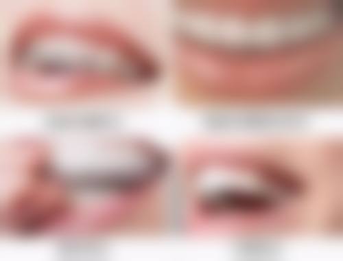 烤瓷牙崩瓷了怎么修复？掌握3种有效方法，让你的牙齿重焕健康光彩，告别崩瓷困扰！ 