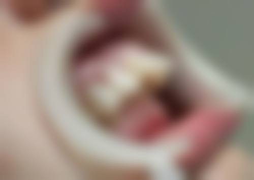 35岁矫正牙齿能拔牙吗