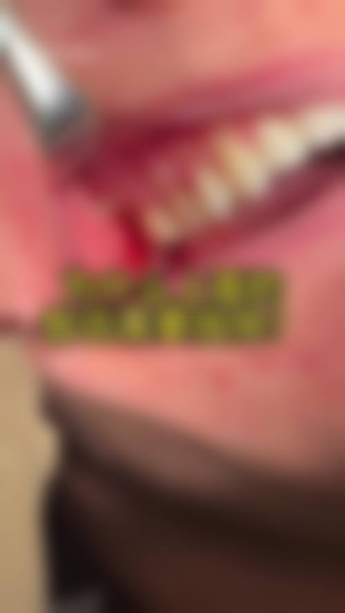 该门诊部提供全方面的口腔医疗服务,其特色项目包括牙齿洁治、根管治疗、牙齿矫正、种植牙和修复牙齿等。其中有具体的品牌项目,比如法国安卓健Anthogyt种植体、德国贝格Bego、西班牙MG、洗牙、金属托槽矫正、钛合金烤瓷牙。这些项目基本覆盖了日常口腔问题和一些较为复杂的口腔疾病治疗,能满足不同患者的需求。