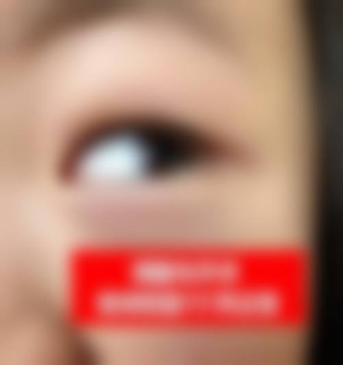 临床实例分享:攀枝花市中医和西医结合医院眼科柴剑